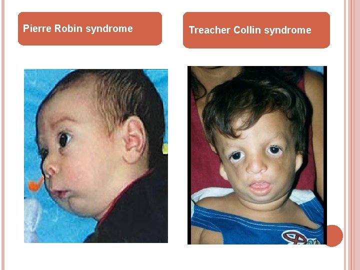 Pierre Robin syndrome Treacher Collin syndrome 