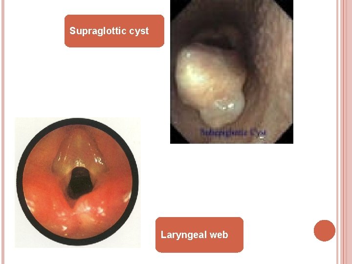 Supraglottic cyst Laryngeal web 