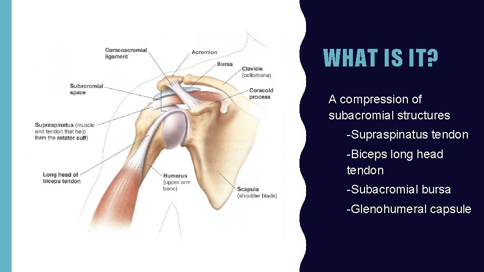 WHAT IS IT? • A compression of subacromial structures – -Supraspinatus tendon – -Biceps