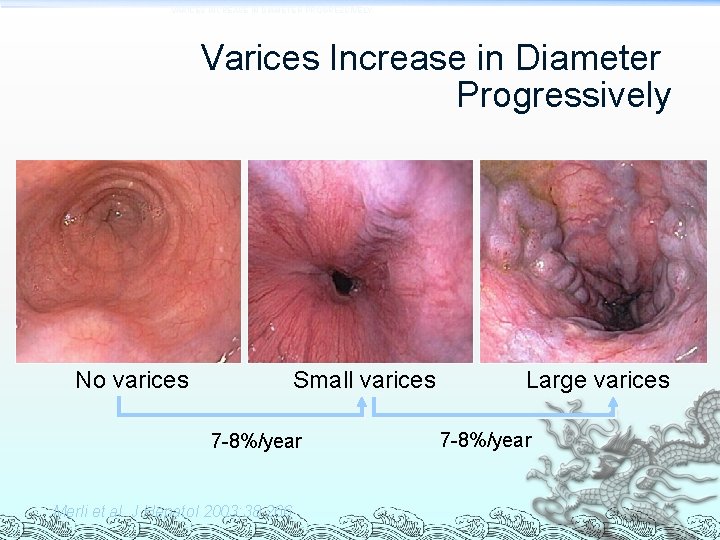 VARICES INCREASE IN DIAMETER PROGRESSIVELY Varices Increase in Diameter Progressively No varices Small varices