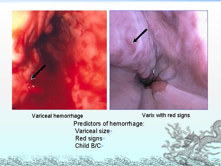 PROGNOSTIC INDICATORS OF FIRST VARICEAL HEMORRHAGE Variceal hemorrhage Varix with red signs Predictors of