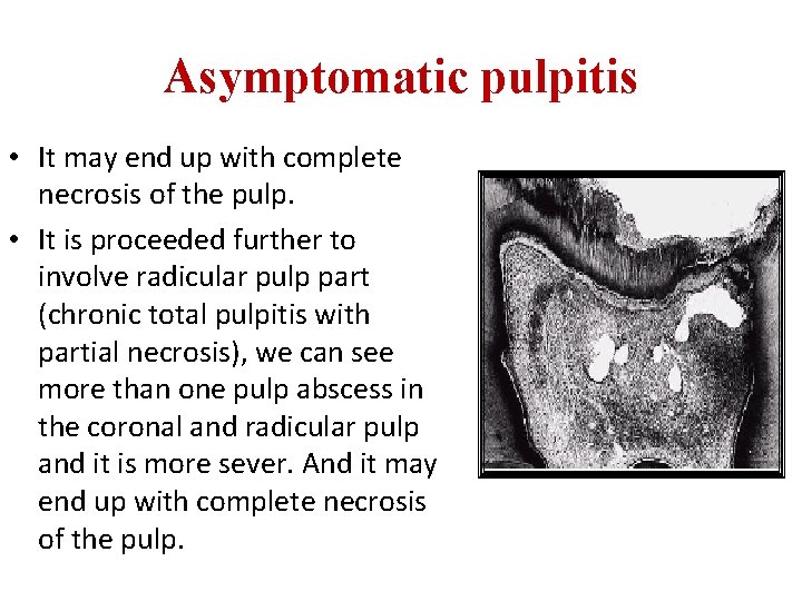 Asymptomatic pulpitis • It may end up with complete necrosis of the pulp. • Asymptomatic pulpitis • It may end up with complete necrosis of the pulp. •