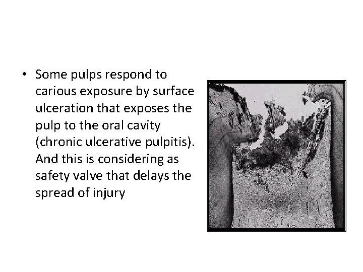 • Some pulps respond to carious exposure by surface ulceration that exposes the • Some pulps respond to carious exposure by surface ulceration that exposes the
