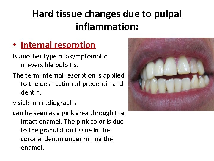 Hard tissue changes due to pulpal inflammation: • Internal resorption Is another type of Hard tissue changes due to pulpal inflammation: • Internal resorption Is another type of