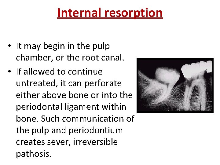 Internal resorption • It may begin in the pulp chamber, or the root canal. Internal resorption • It may begin in the pulp chamber, or the root canal.