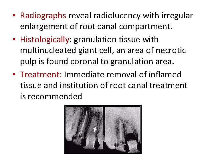• Radiographs reveal radiolucency with irregular enlargement of root canal compartment. • Histologically: • Radiographs reveal radiolucency with irregular enlargement of root canal compartment. • Histologically: