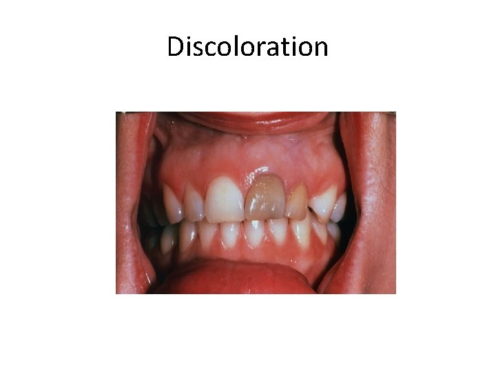 Discoloration Discoloration