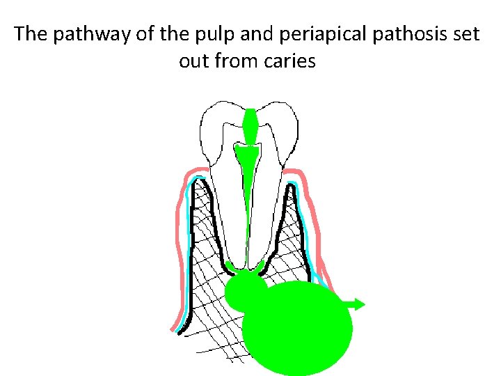 The pathway of the pulp and periapical pathosis set out from caries The pathway of the pulp and periapical pathosis set out from caries