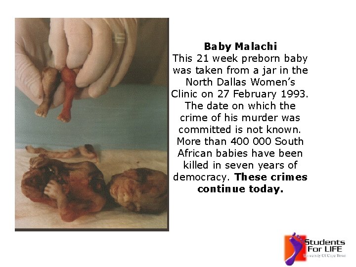 Baby Malachi This 21 week preborn baby was taken from a jar in the