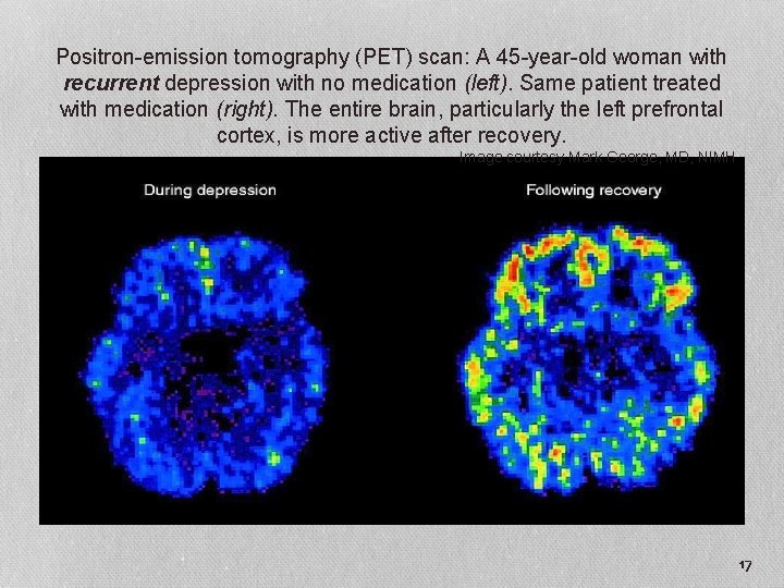 Positron-emission tomography (PET) scan: A 45 -year-old woman with recurrent depression with no medication