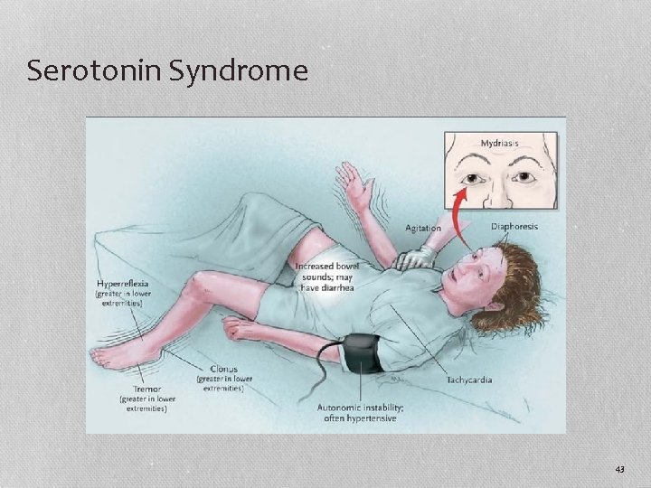 Serotonin Syndrome 43 
