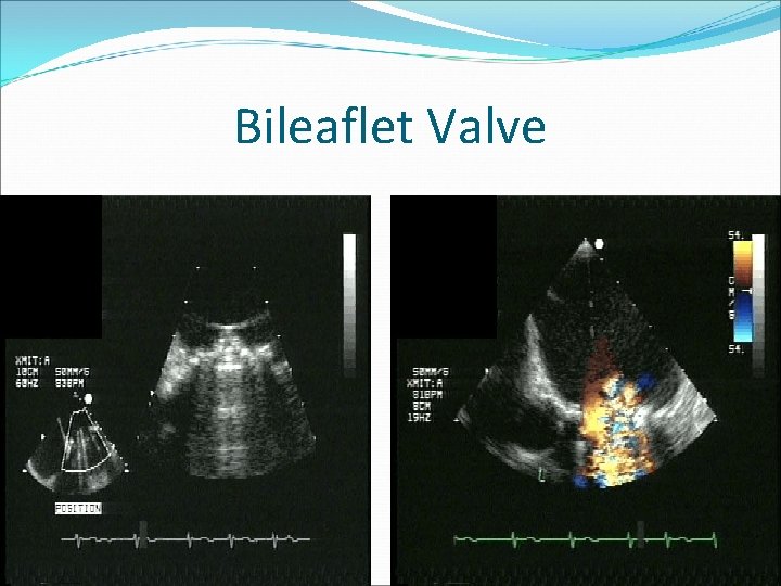 Bileaflet Valve 