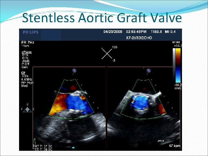 Stentless Aortic Graft Valve 