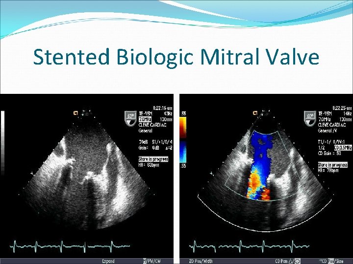 Stented Biologic Mitral Valve 