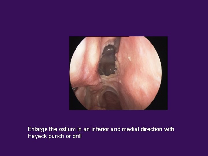 Enlarge the ostium in an inferior and medial direction with Hayeck punch or drill