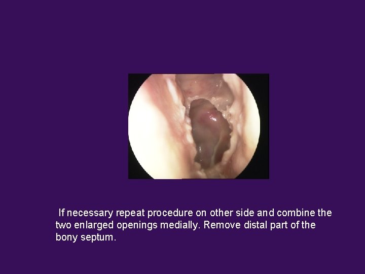 If necessary repeat procedure on other side and combine the two enlarged openings medially.
