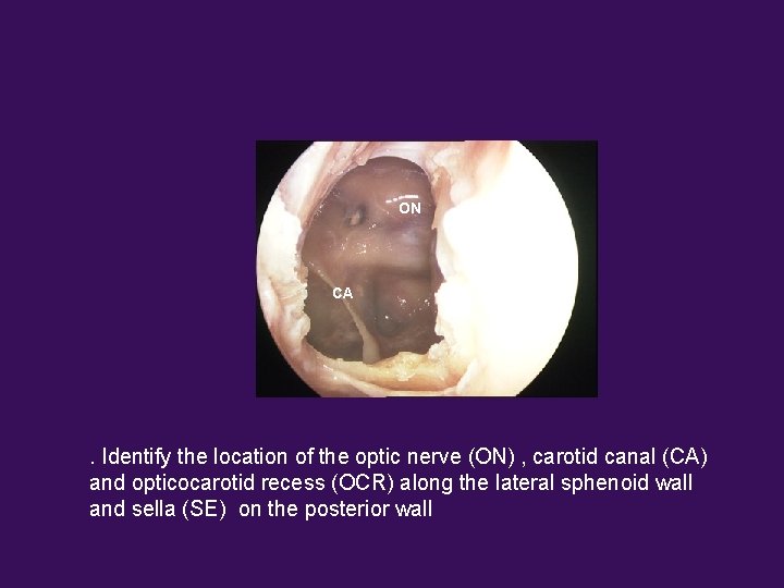 ON CA . Identify the location of the optic nerve (ON) , carotid canal