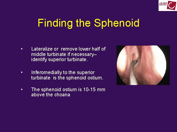 Finding the Sphenoid • Lateralize or remove lower half of middle turbinate if necessary–