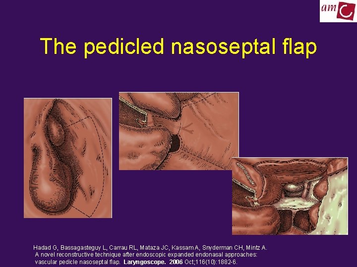 The pedicled nasoseptal flap Hadad G, Bassagasteguy L, Carrau RL, Mataza JC, Kassam A,