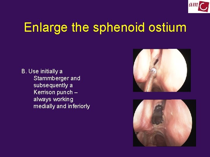 Enlarge the sphenoid ostium B. Use initially a Stammberger and subsequently a Kerrison punch