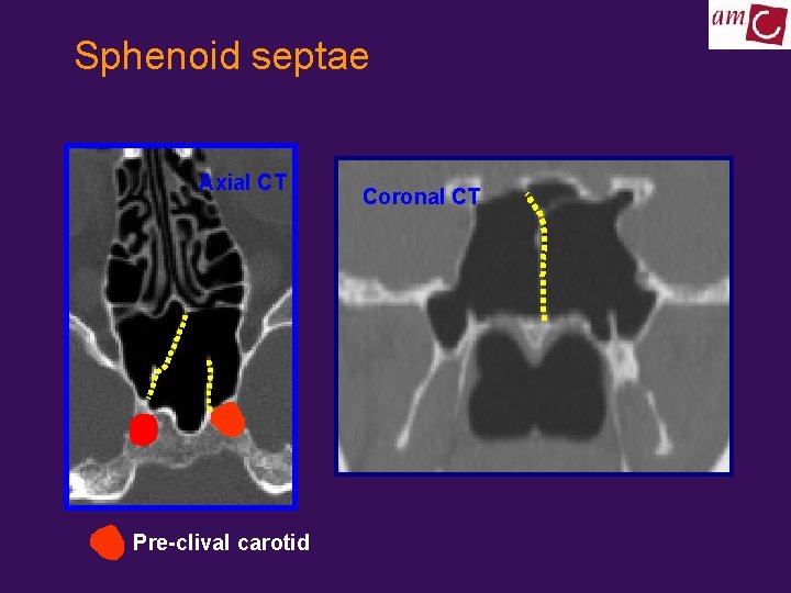 Sphenoid septae Axial CT Pre-clival carotid Coronal CT 