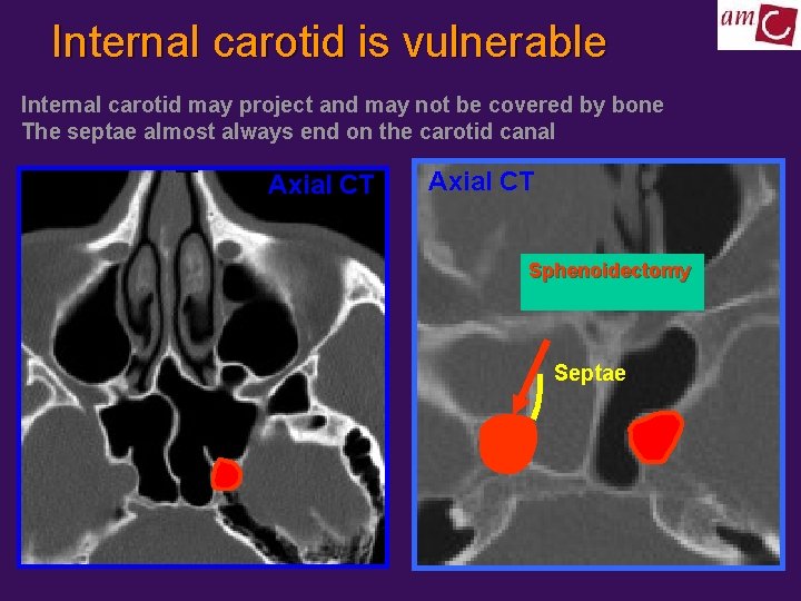 Internal carotid is vulnerable Internal carotid may project and may not be covered by