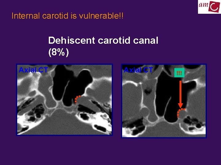 Internal carotid is vulnerable!! Dehiscent carotid canal (8%) Axial CT !!! 