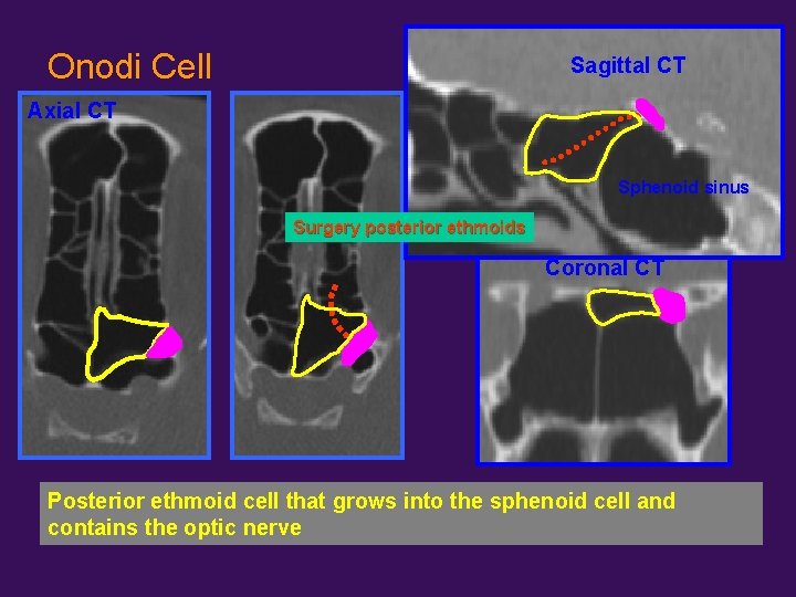 Onodi Cell Sagittal CT Axial CT Sphenoid sinus Surgery posterior ethmoids Coronal CT Posterior