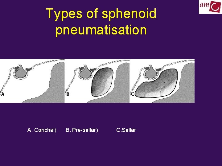 Types of sphenoid pneumatisation A. Conchal) B. Pre-sellar) C. Sellar 