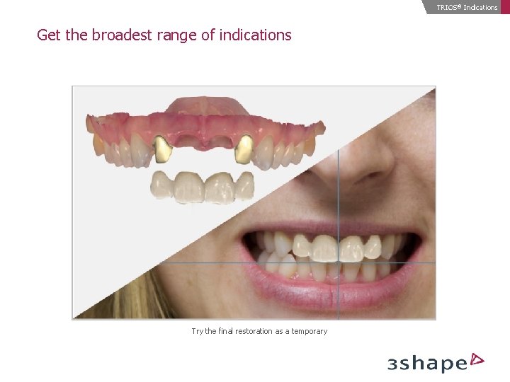 TRIOS® Indications Get the broadest range of indications Try the final restoration as a