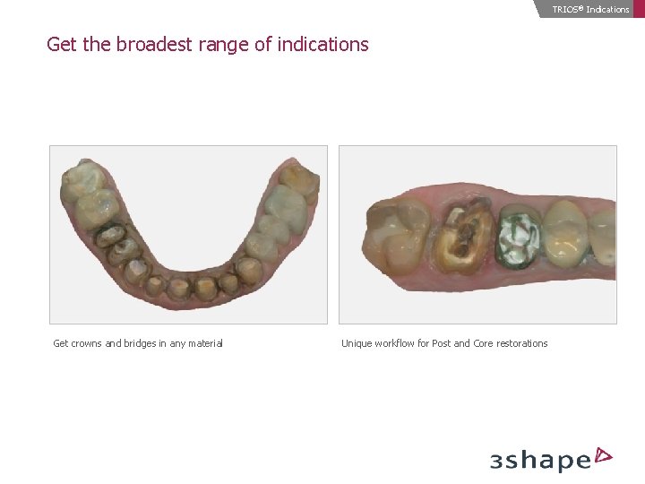 TRIOS® Indications Get the broadest range of indications Get crowns and bridges in any