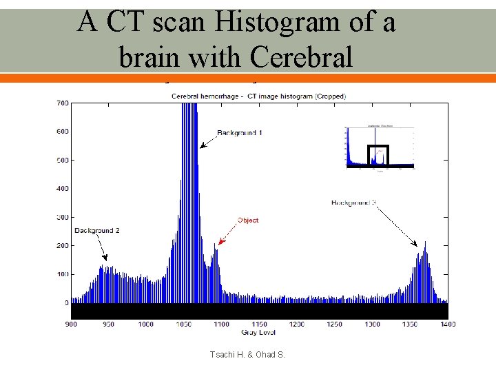 A CT scan Histogram of a brain with Cerebral hemorrhage Tsachi H. & Ohad