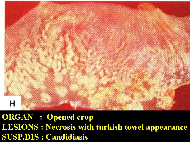 ORGAN : Opened crop LESIONS : Necrosis with turkish towel appearance SUSP. DIS :