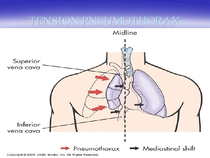 TENSION PNEUMOTHORAX 