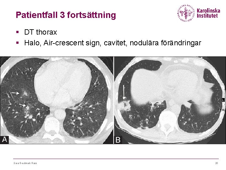 Patientfall 3 fortsättning § DT thorax § Halo, Air-crescent sign, cavitet, nodulära förändringar Sara
