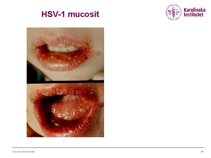 HSV-1 mucosit Sara Gredmark Russ 30 