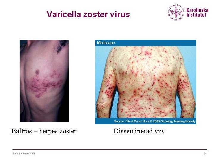 Varicella zoster virus Bältros – herpes zoster Sara Gredmark Russ Disseminerad vzv 34 