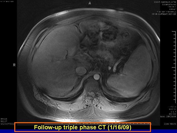 Follow-up triple phase CT (1/16/09) 