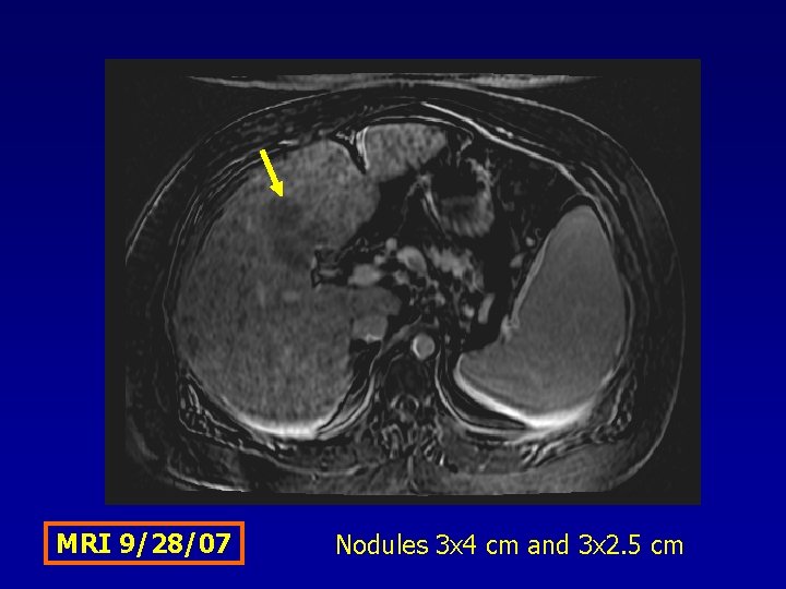 MRI 9/28/07 Nodules 3 x 4 cm and 3 x 2. 5 cm 