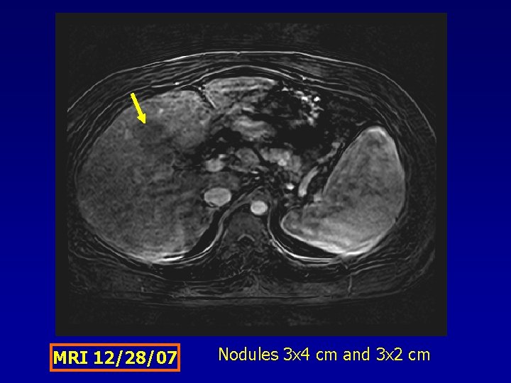 MRI 12/28/07 Nodules 3 x 4 cm and 3 x 2 cm 