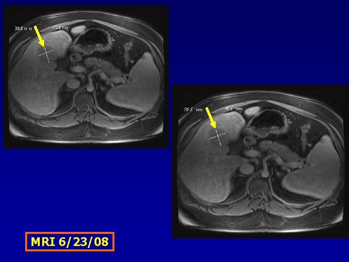MRI 6/23/08 