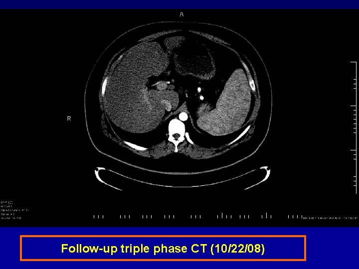 Follow-up triple phase CT (10/22/08) 