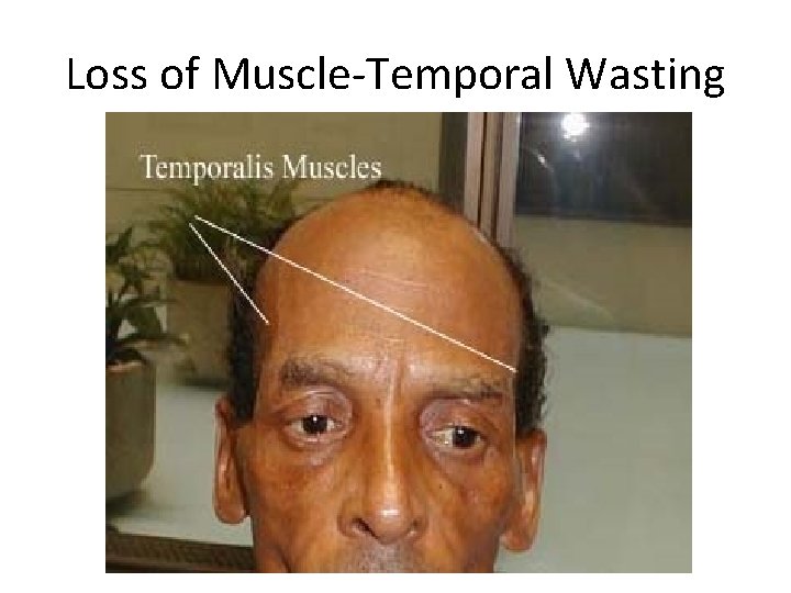 Loss of Muscle-Temporal Wasting 