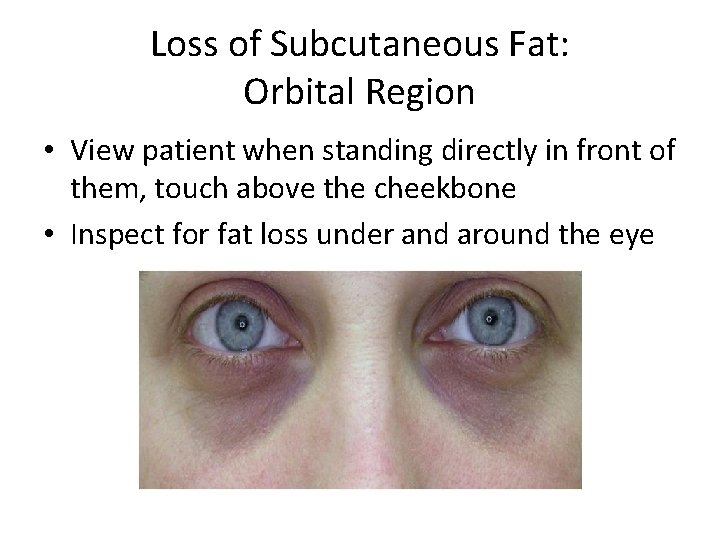 Loss of Subcutaneous Fat: Orbital Region • View patient when standing directly in front