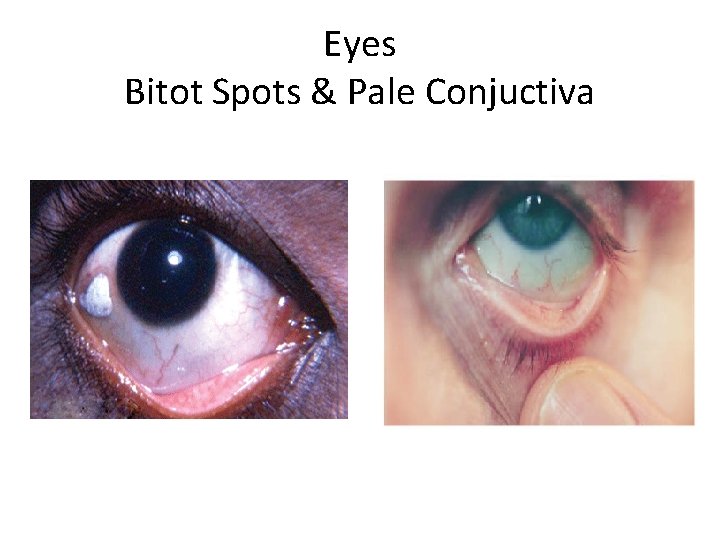 Eyes Bitot Spots & Pale Conjuctiva 