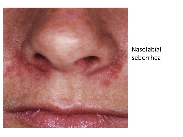 Nasolabial seborrhea 