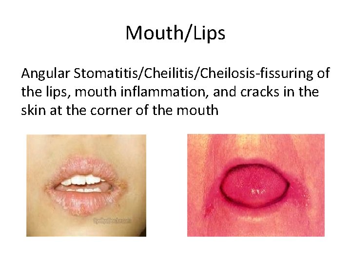 Mouth/Lips Angular Stomatitis/Cheilosis-fissuring of the lips, mouth inflammation, and cracks in the skin at