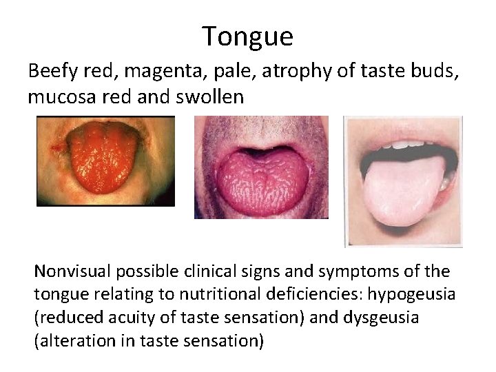 Tongue Beefy red, magenta, pale, atrophy of taste buds, mucosa red and swollen Nonvisual