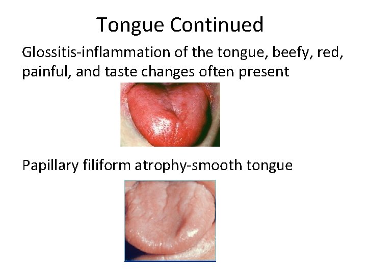 Tongue Continued Glossitis-inflammation of the tongue, beefy, red, painful, and taste changes often present