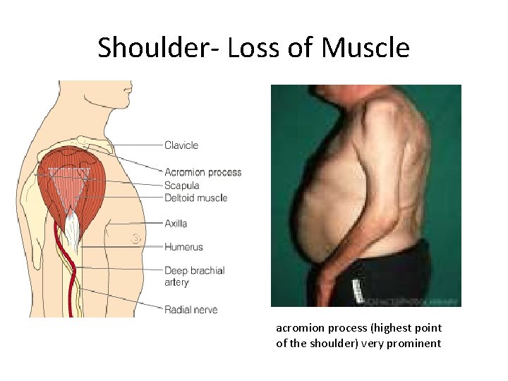Shoulder- Loss of Muscle acromion process (highest point of the shoulder) very prominent 